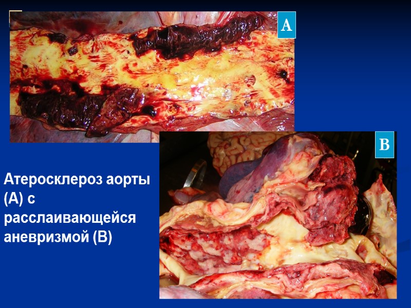 Атеросклероз аорты  (А) с расслаивающейся аневризмой (В) А В